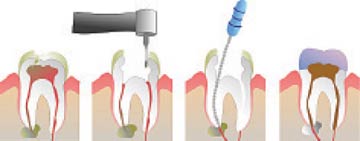 Saluran akar perawatan gigi biaya Pengertian Perawatan