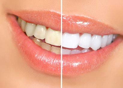 tooth whitening bleaching