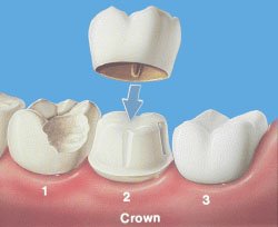 Mahkota tiruan (dental crown)