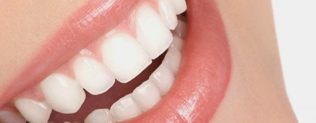 Hasil dari pemutihan Gigi. Gigi putih sehat alami