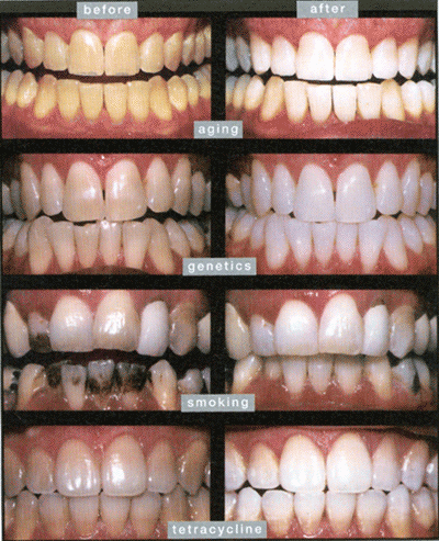 Perbedaan gigi sebelum dan sesudah memutihkan gigi secara alami