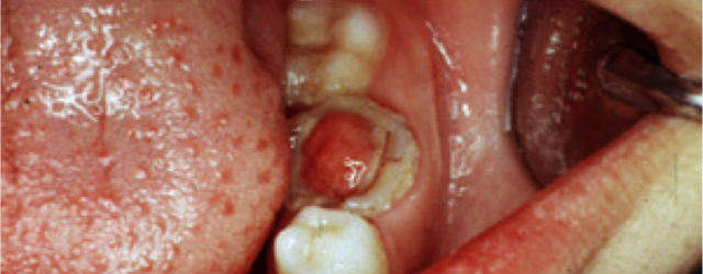 Fakta tentang Flouride & Kerusakan Dentin