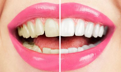 “Bleaching” Gigi Kembalikan Warna Cemerlang Gigi
