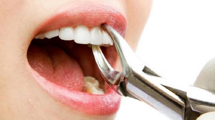 Mengenal berbagai alasan gigi dicabut, Sumber: toothsignature.com