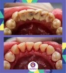 Karang gigi menyebabkan radang gusi