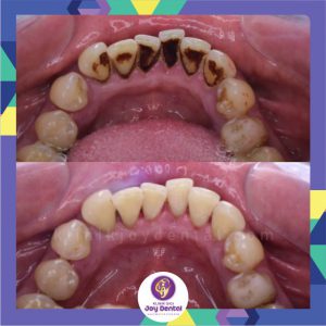 Scaling Gigi atau Pembersihan karang gigi di joy dental