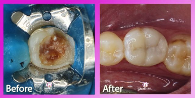 Hasil Tambal-gigi Joy Dental Jogja | Penambalan Gigi