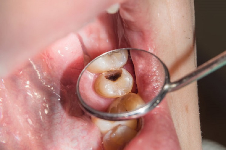 Kondisi gigi yang berlubang, Sumber: 1111dental.com