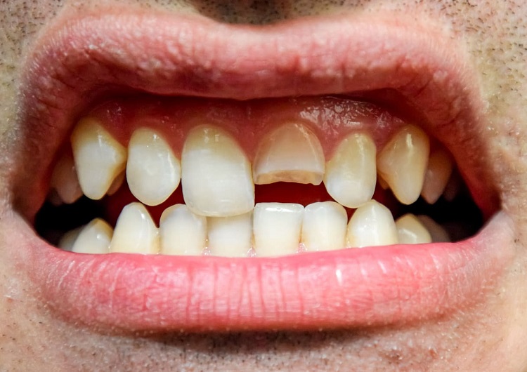 Ilustrasi gigi yang patah, Sumber: honestdocs.id