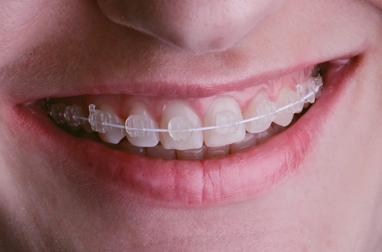 Ilustrasi penggunaan kawat gigi transparan, Sumber: westchasesmilesinstitute.com