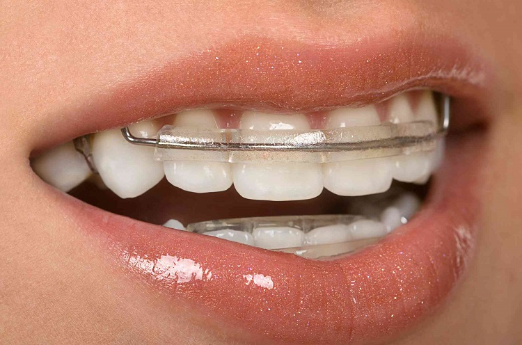 Pemakaian retainer gigi setelah penggunaan behel, Sumber: westoverhillsfamilydental.com