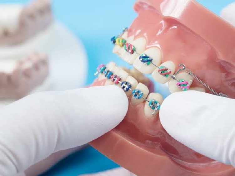 Pemasangan kawat gigi di dokter gigi spesialis ortodonti, Sumber: gelarsramdhani.com