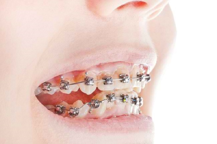 Penggunaan behel untuk mengatasi gigi tonggos, Sumber: alodokter.com