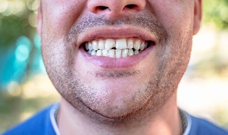 Bentuk dari gigi depan yang patah, Sumber: sehatq.com