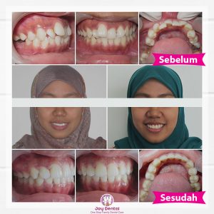Hasil-perawatan-ukuran-rahang-dan-gigi-tidak-sesuai-Joy-Dental