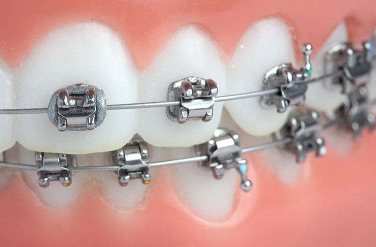 Pasang behel tanpa cabut gigi dengan teknologi damon, Sumber: zeedent.ae