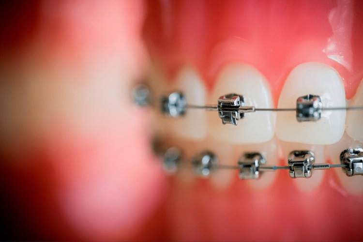 Pemasangan behel damon wajib dilakukan oleh dokter gigi spesialis ortodontik profesional, Sumber: orthodontistwilmington.com