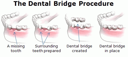 Dental Bridge Procedure/ Gigi tiruan