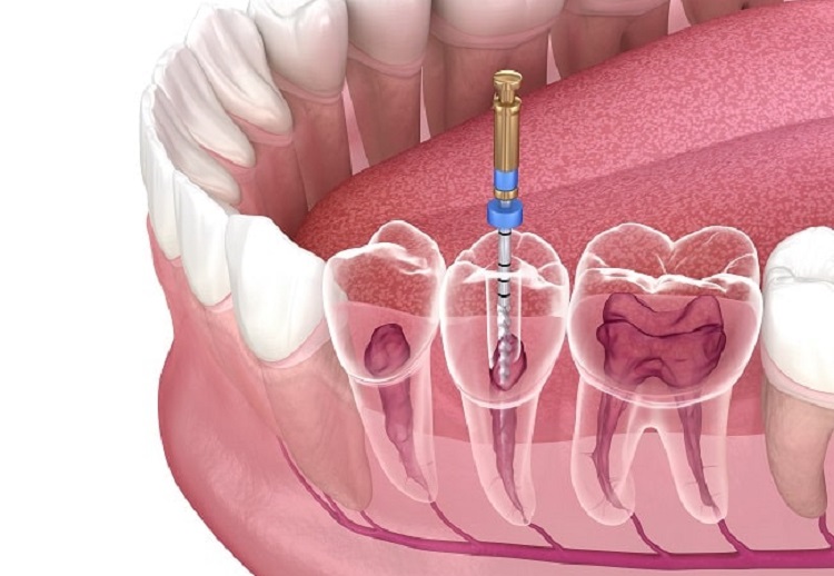 Informasi terkait berapa lama perawatan saluran akar gigi berlangsung, Sumber: alomedika.com
