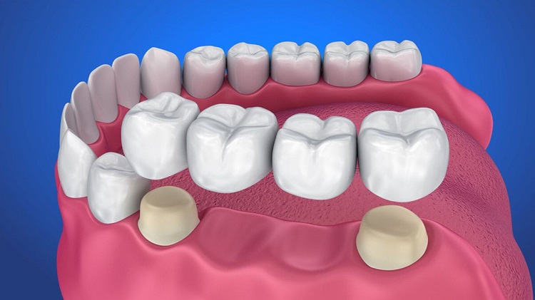 Ilustrasi pemasangan dental bridge, Sumber: klikdokter.com