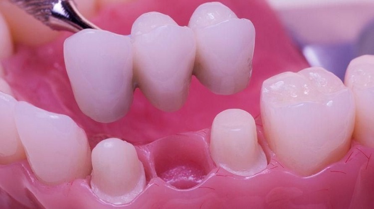 Penggunaan gigi bridge, Sumber: sehatq.com