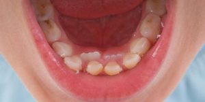 Contoh masalah pada gigi anak