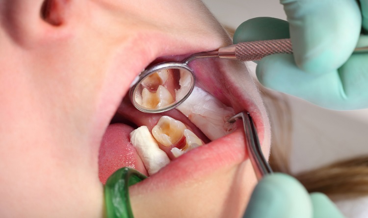 Sakit gigi seperti kesetrum bisa disebabkan karena gigi berlubang, Sumber: niknock.my