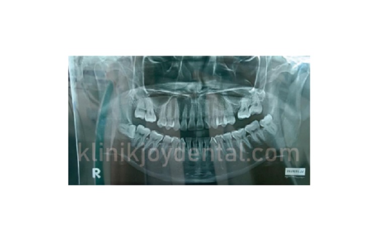 Hasil rotgen area gigi, Sumber: doc pribadi