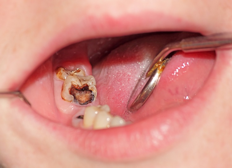 Informasi terkait bahaya membiarkan gigi berlubang, Sumber: alodokter.com