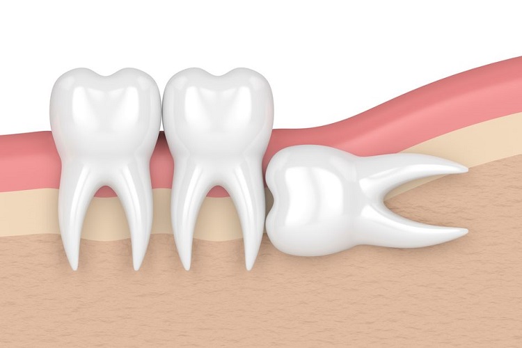 Odontektomi adalah solusi impaksi gigi bungsu, Sumber: kompas.com
