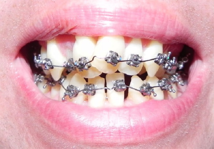 Bahaya menggunakan kawat gigi palsu, Sumber: drjacquiesmiles.com
