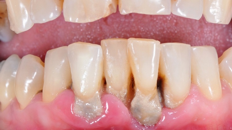 Informasi terkait periodontitis kronis, Sumber: klikdokter.com