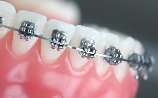 Efek samping pemakaian kawat gigi