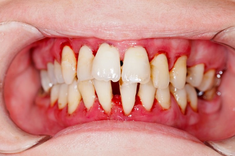 Mengenal penyebab dari periodontitis, Sumber: friscoperio.com