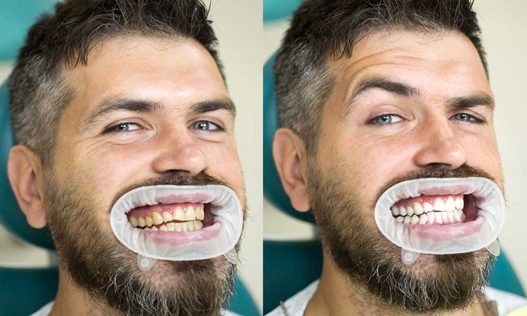 Mengetahui prosedur bleaching gigi, Sumber: familyandcosmeticdentist.com