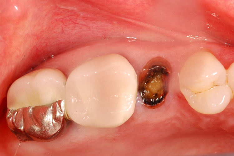 Akar gigi yang menyisa dapat menyebabkan berbagai kemungkinan buruk, Sumber: soundtoothdental.com