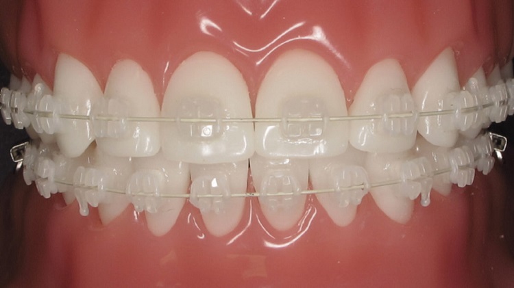 Ilustrasi kawat gigi transparan, Sumber: barriedentist.ca