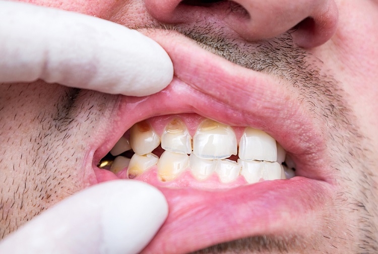Salah satu efek akibat rusaknya enamel gigi, Sumber: pueblodental.com