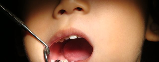 Pemasangan kawat gigi pada anak