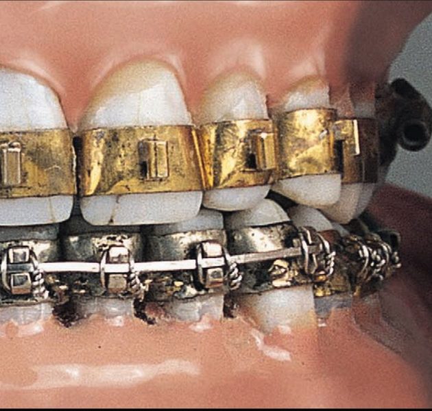 Kawat Gigi pertama di dunia