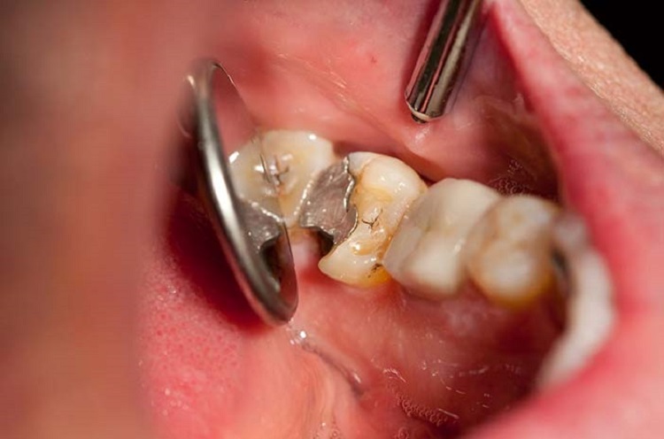 Informasi terkait cara mengatasi gigi keropos, Sumber: halodoc.com