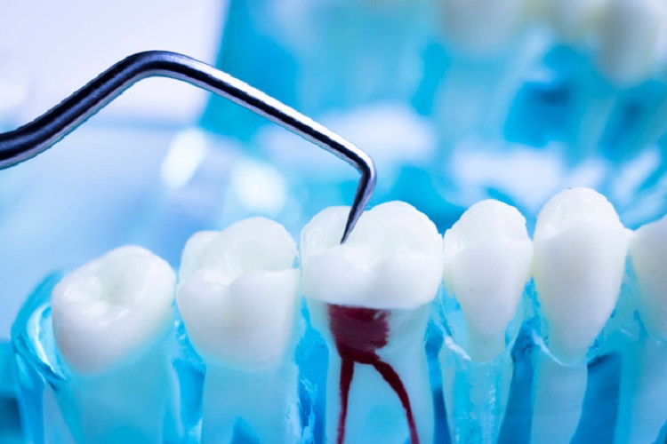 Melakukan perawatan saluran akar gigi, Sumber: hdmall.id