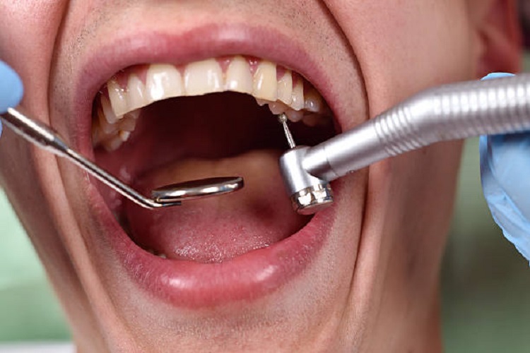 Inovasi terbaru mengenai alat bor gigi bermusik, Sumber: istockphoto.com