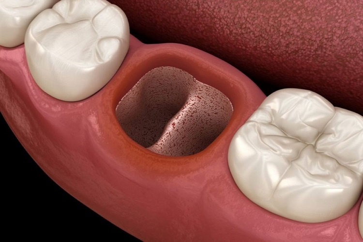 Kondisi mulut setelah cabut gigi, Sumber: mhdc.co.id