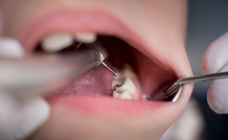 Penggunaan alat bor gigi, Sumber: honestdocs.id