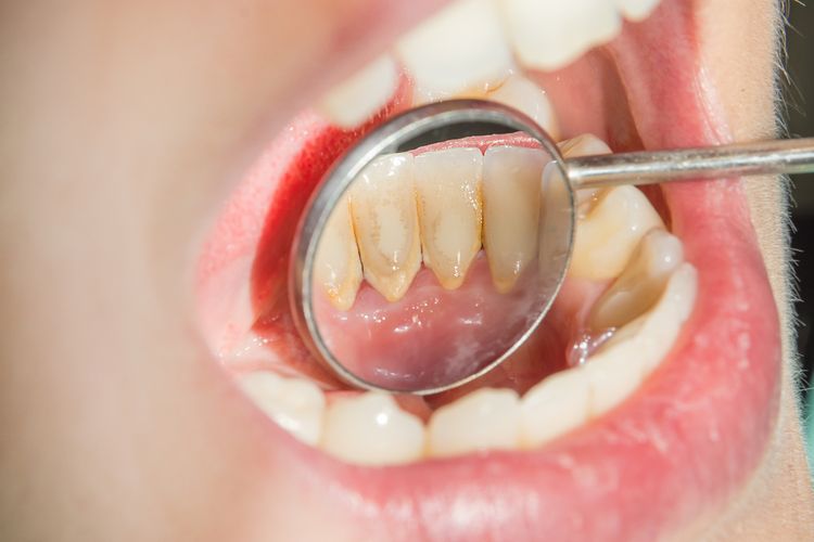 Penyebab gigi berdarah bisa dikarenakan adanya karang gigi yang menumpuk, Sumber: kompas.com