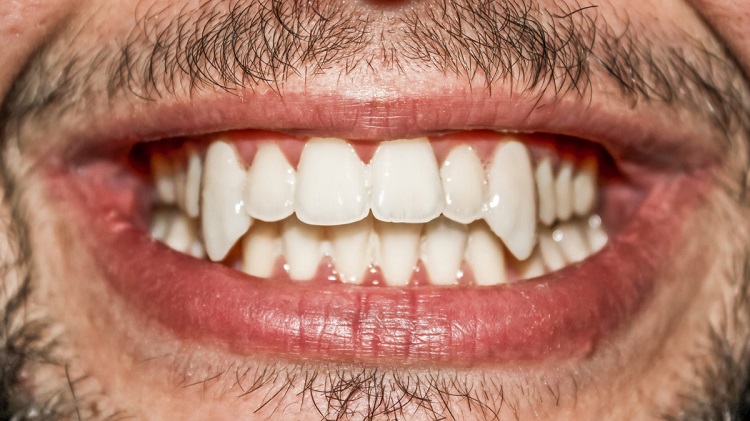 Informasi terkait bagaimana cara mengatasi gigi taring yang tumbuh di tengah, Sumber: klikdokter.com
