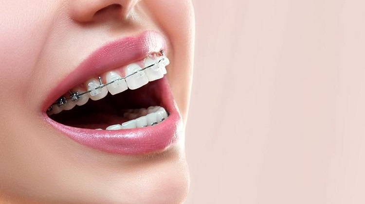Penggunaan behel menjadi salah satu cara mengatasi pertumbuhan gigi taring yang salah, Sumber: sehatq.com