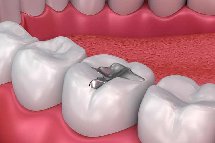 Informasi terkait apakah gigi yang sudah ditambal bisa berlubang lagi, Sumber: infinitydentalspringlake.com