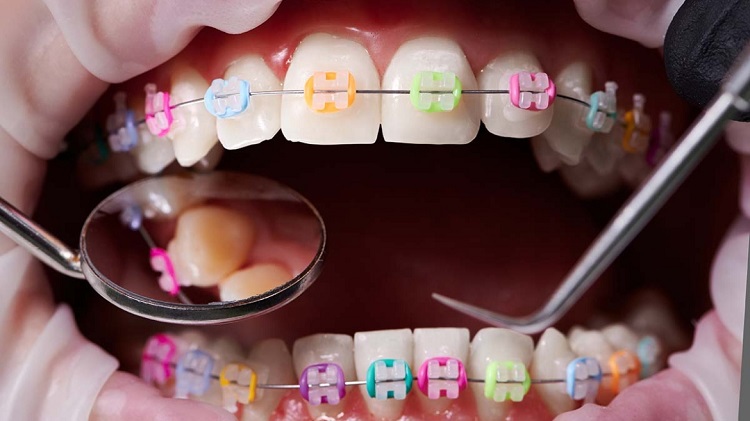 Cara merawat behel gigi yang tepat, Sumber: victoryplazadental.com